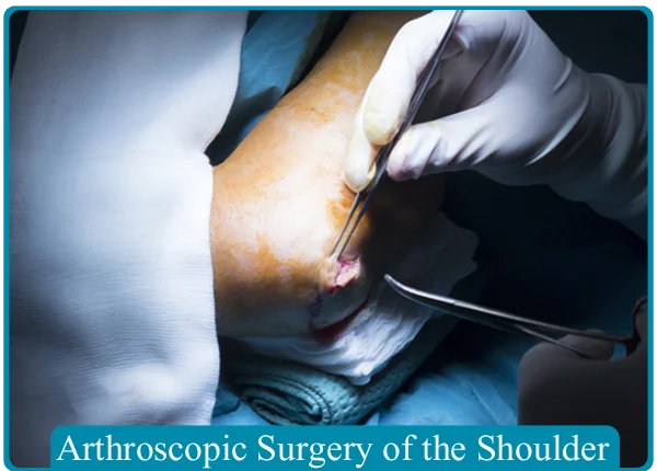 Arthroscopic Surgery Of  Shoulder