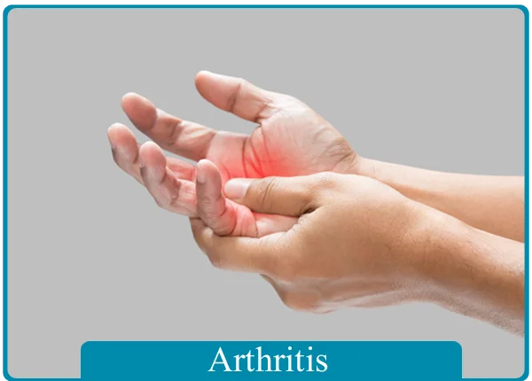 Arthritis